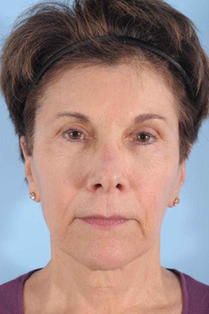 Neck Lift Before & After Gallery - Patient 111523 - Image 3