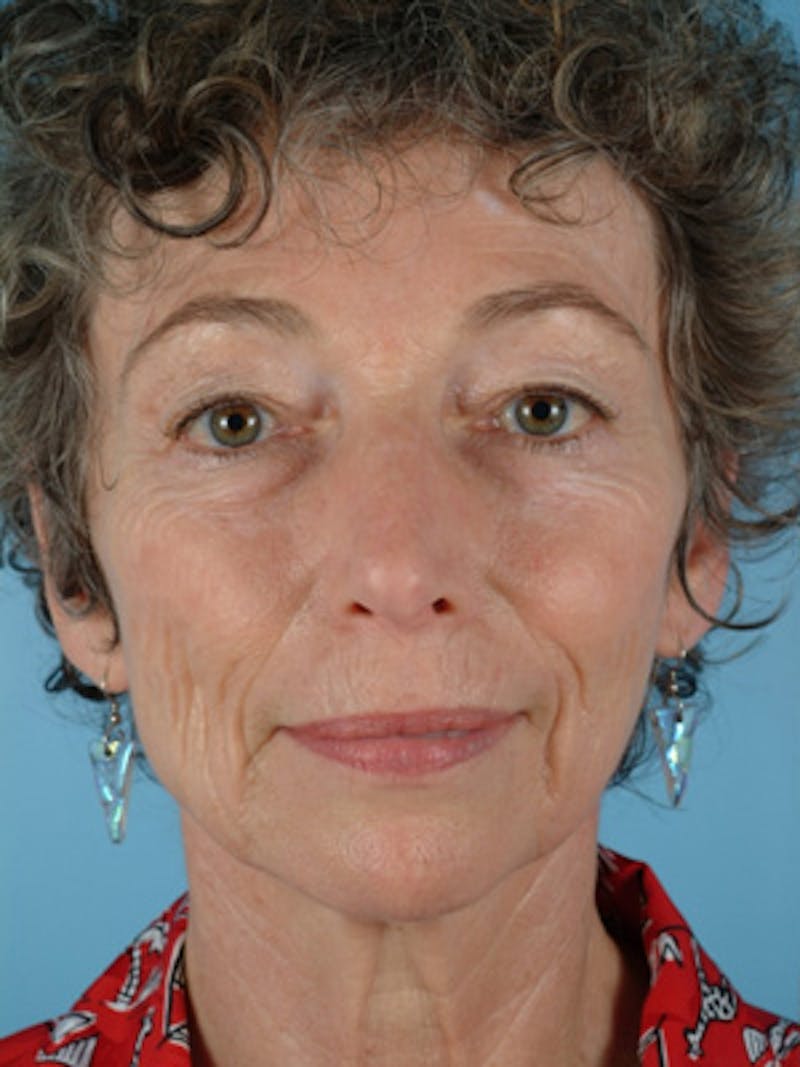 Upper Blepharoplasty Before & After Gallery - Patient 119672 - Image 1