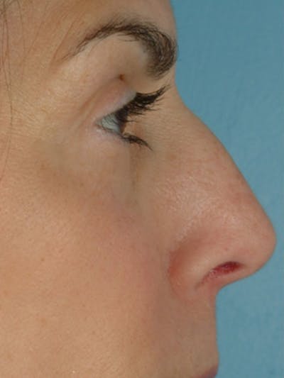 Rhinoplasty Before & After Gallery - Patient 115766 - Image 1