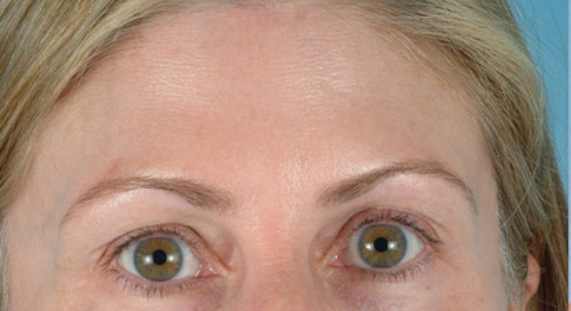 Upper Blepharoplasty Before & After Gallery - Patient 804933 - Image 1