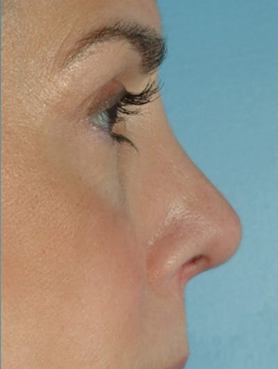 Rhinoplasty Before & After Gallery - Patient 115766 - Image 2