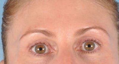 Upper Blepharoplasty Before & After Gallery - Patient 804933 - Image 2