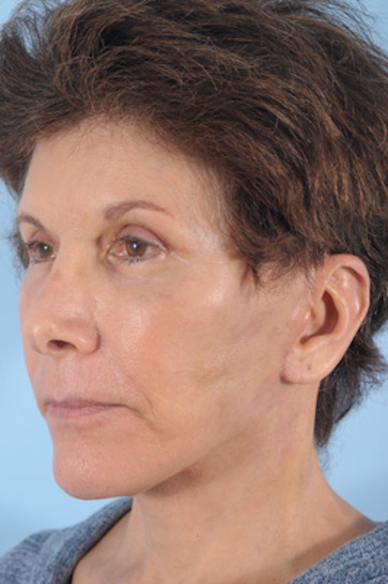 Neck Lift Before & After Gallery - Patient 111523 - Image 6