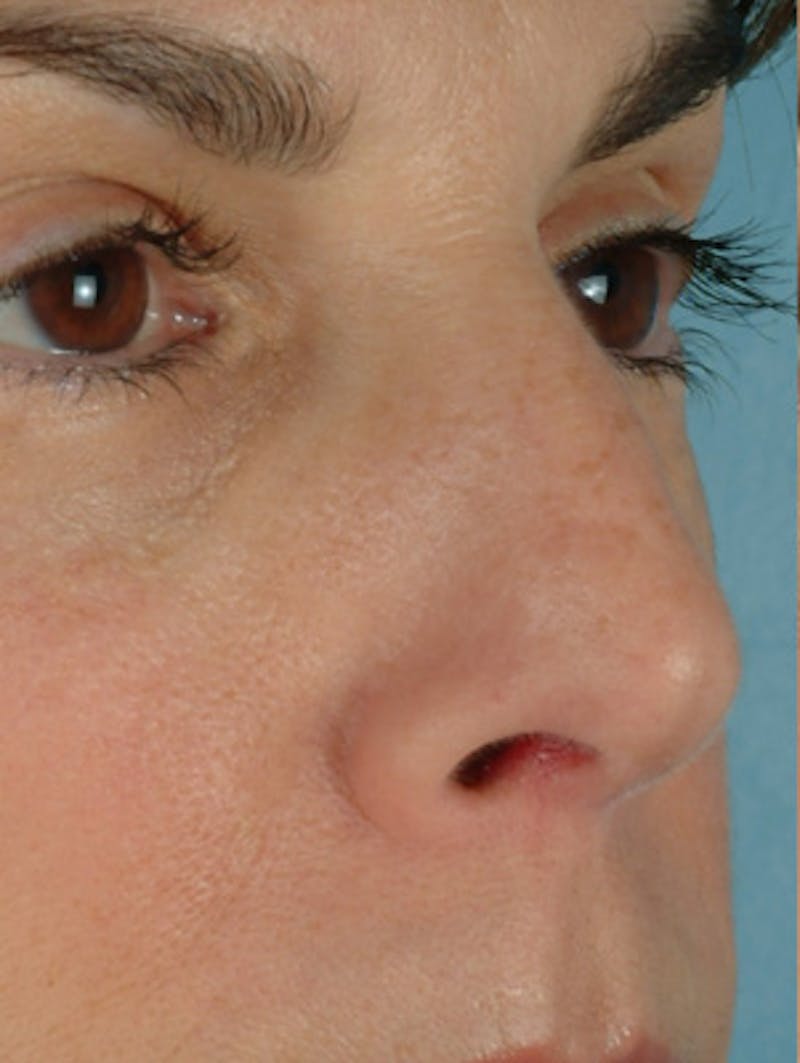 Rhinoplasty Before & After Gallery - Patient 115766 - Image 3