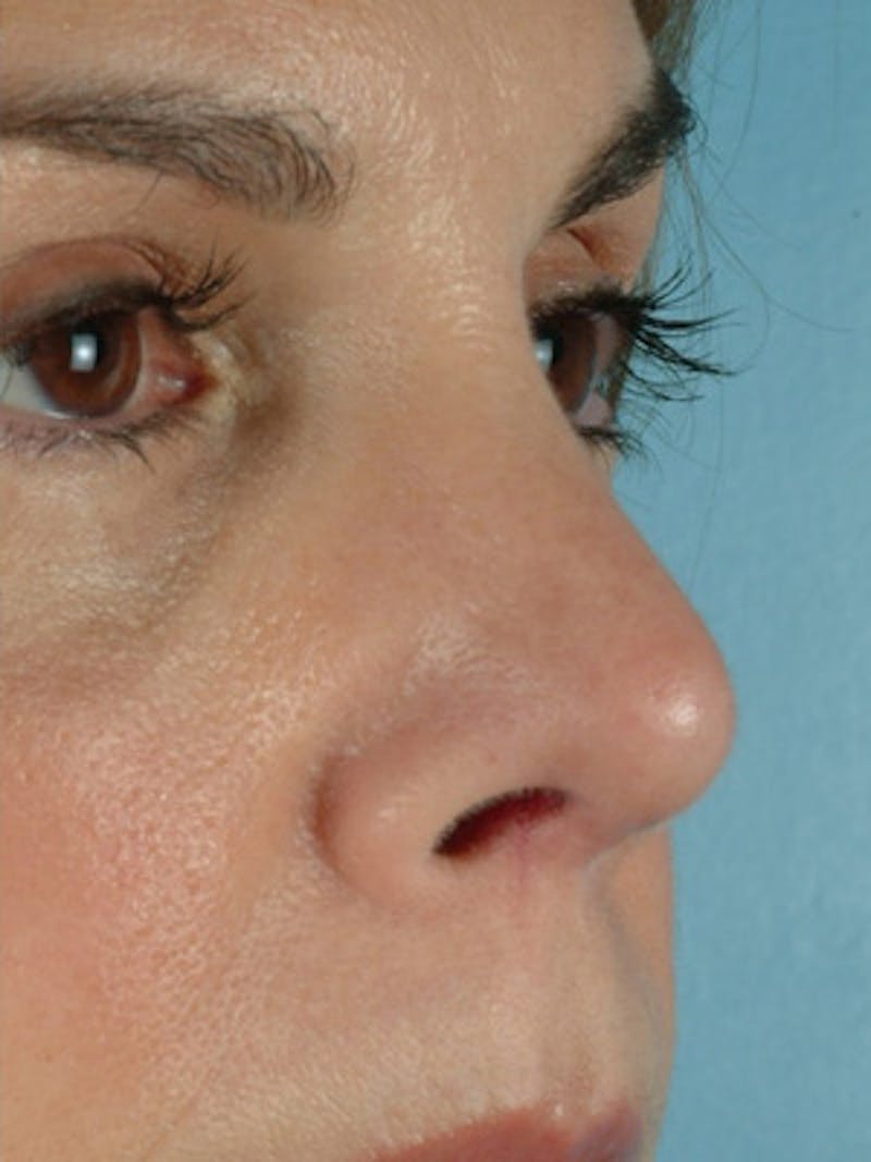 Rhinoplasty Before & After Gallery - Patient 115766 - Image 4