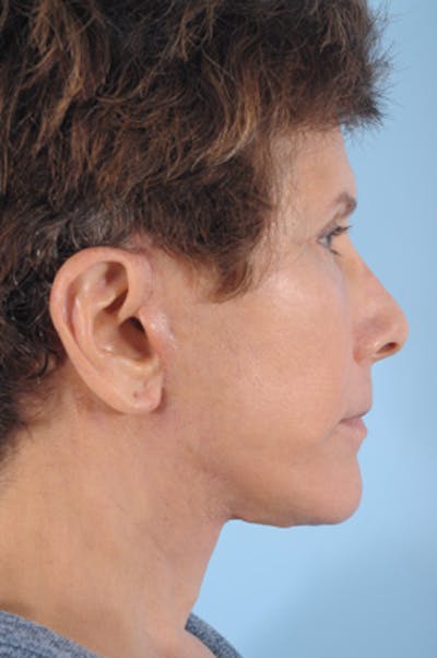 Neck Lift Before & After Gallery - Patient 111523 - Image 2