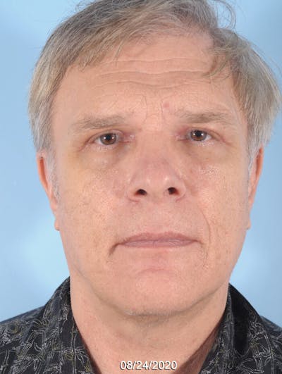 Upper Blepharoplasty Before & After Gallery - Patient 196884 - Image 2