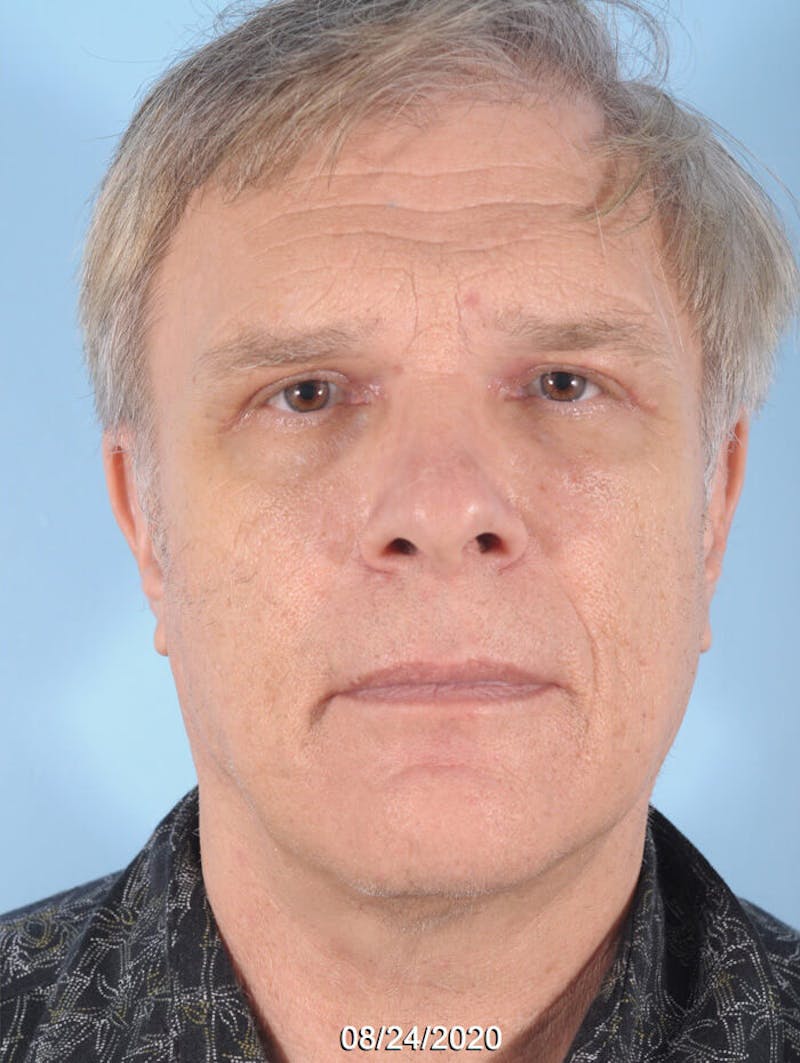 Upper Blepharoplasty Before & After Gallery - Patient 196884 - Image 2