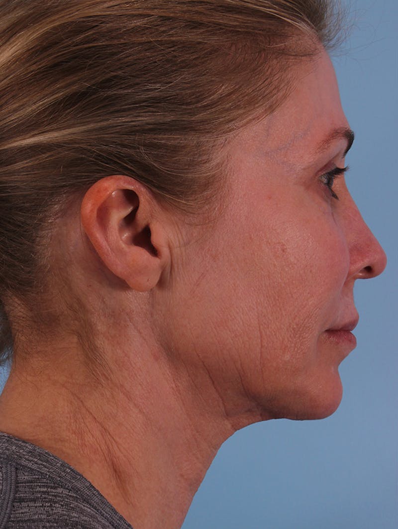 Neck Lift Before & After Gallery - Patient 132042 - Image 1