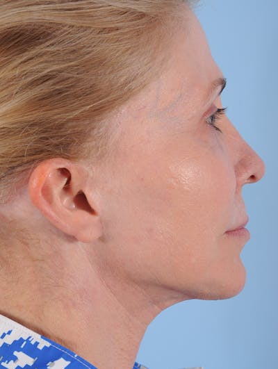 Neck Lift Before & After Gallery - Patient 132042 - Image 2