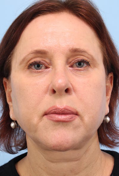 Upper Blepharoplasty Before & After Gallery - Patient 420915 - Image 2