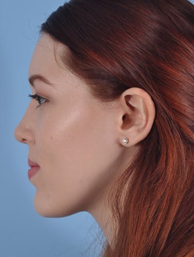 Rhinoplasty Before & After Gallery - Patient 423387 - Image 2