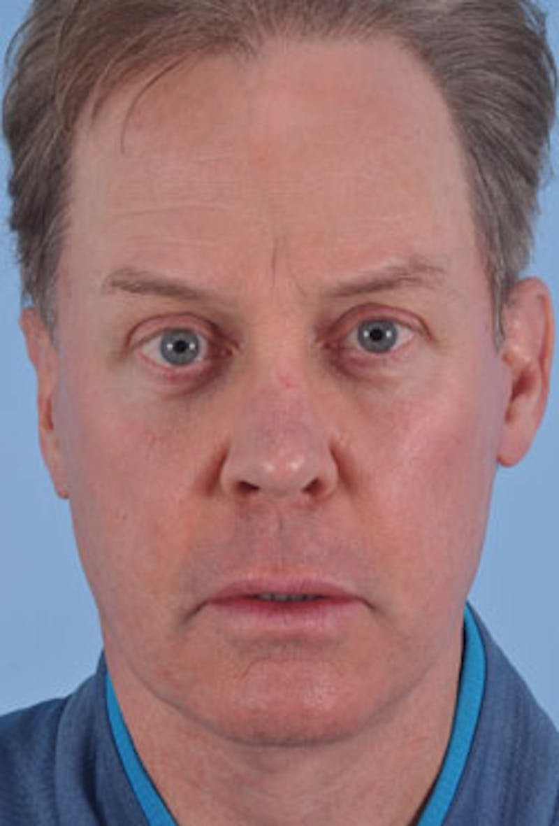 Neck Lift Before & After Gallery - Patient 305053 - Image 4