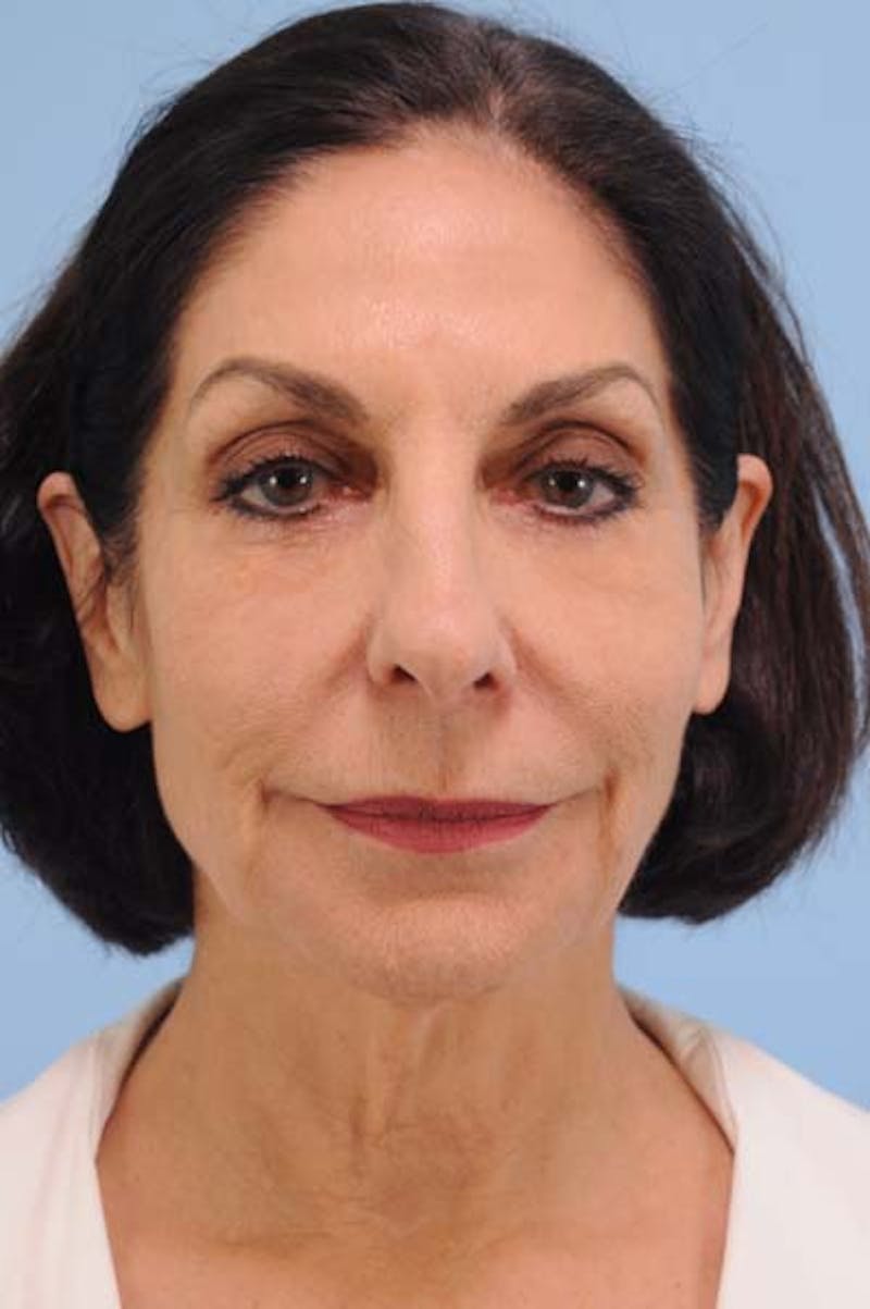 Rhinoplasty Before & After Gallery - Patient 208473 - Image 3