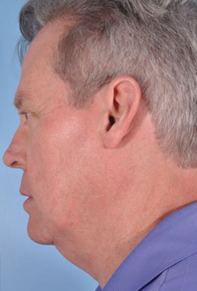 Neck Lift Before & After Gallery - Patient 305053 - Image 1