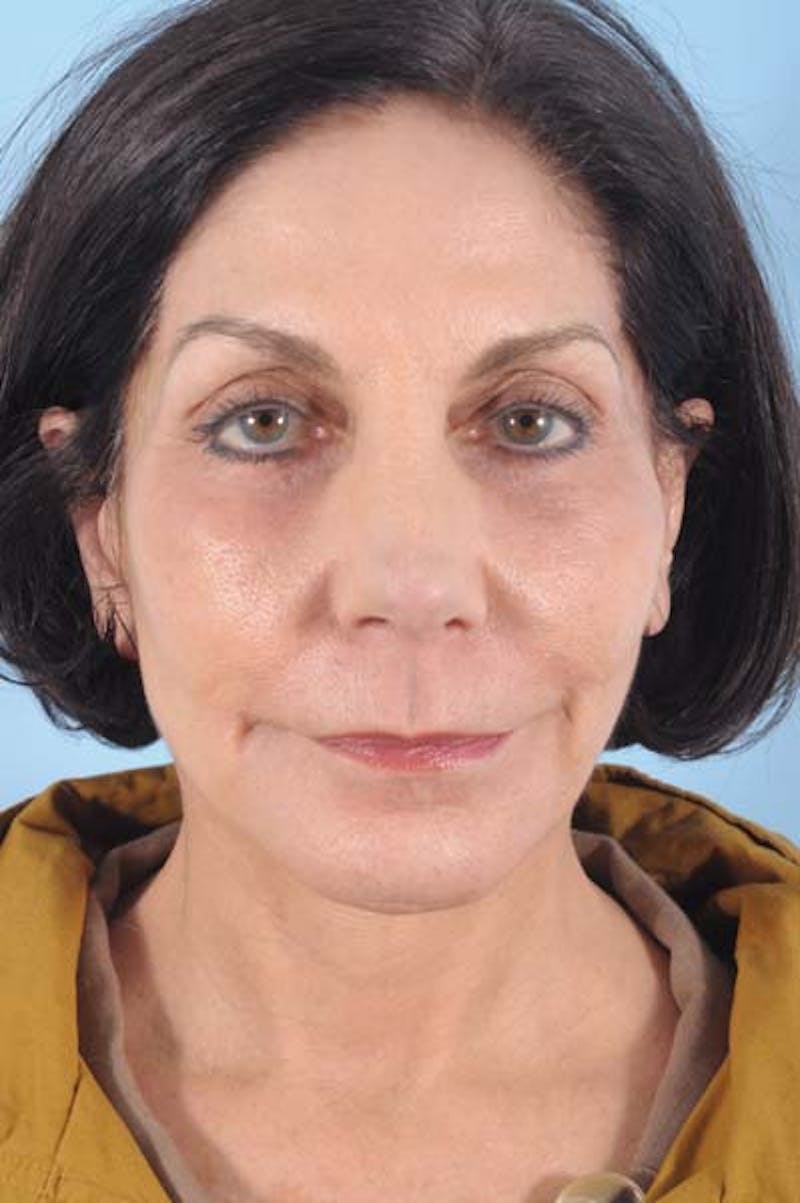 Rhinoplasty Before & After Gallery - Patient 208473 - Image 4