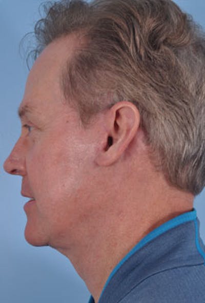 Neck Lift Before & After Gallery - Patient 305053 - Image 2