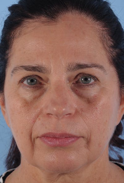 Upper Blepharoplasty Before & After Gallery - Patient 135495 - Image 1