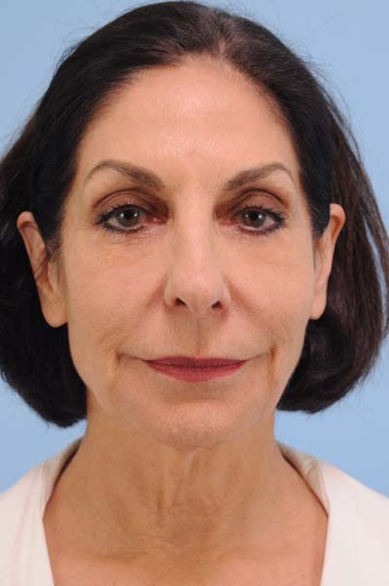 Neck Lift Before & After Gallery - Patient 413593 - Image 3