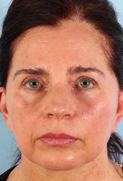 Upper Blepharoplasty Before & After Gallery - Patient 135495 - Image 2