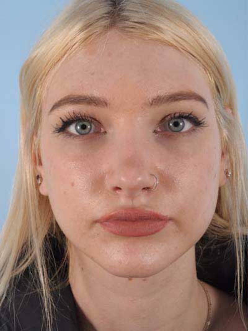Rhinoplasty Before & After Gallery - Patient 291106 - Image 3