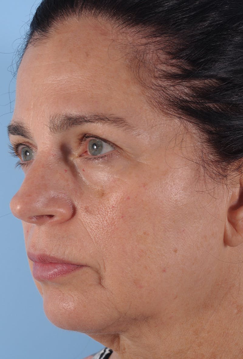 Upper Blepharoplasty Before & After Gallery - Patient 135495 - Image 3