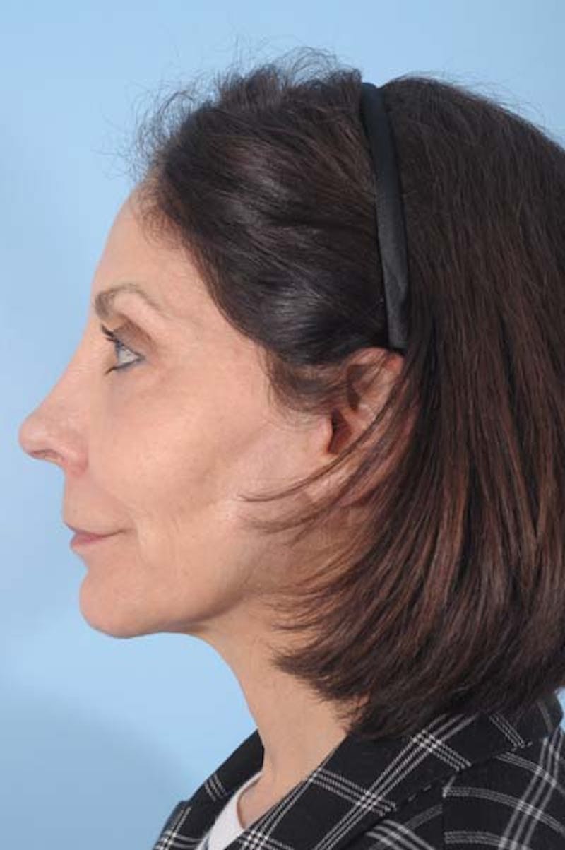 Neck Lift Before & After Gallery - Patient 413593 - Image 2