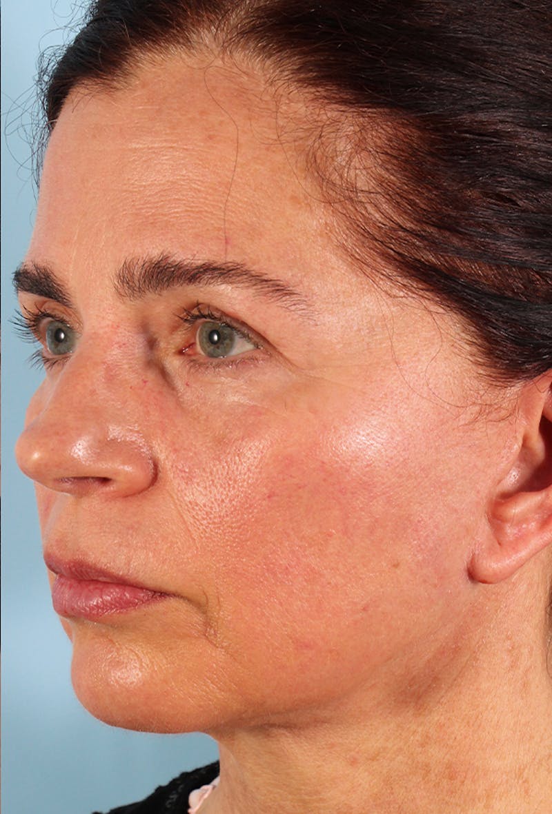 Upper Blepharoplasty Before & After Gallery - Patient 135495 - Image 4