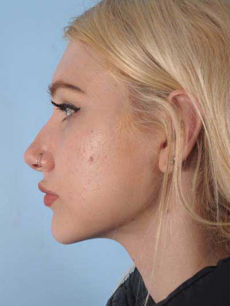Rhinoplasty Before & After Gallery - Patient 291106 - Image 1