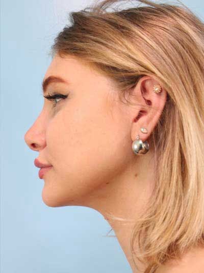 Rhinoplasty Before & After Gallery - Patient 291106 - Image 2