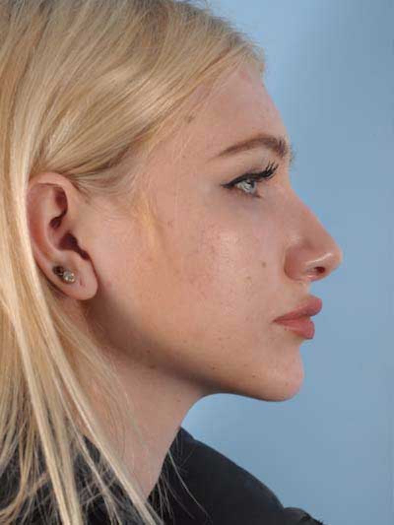 Rhinoplasty Before & After Gallery - Patient 291106 - Image 5