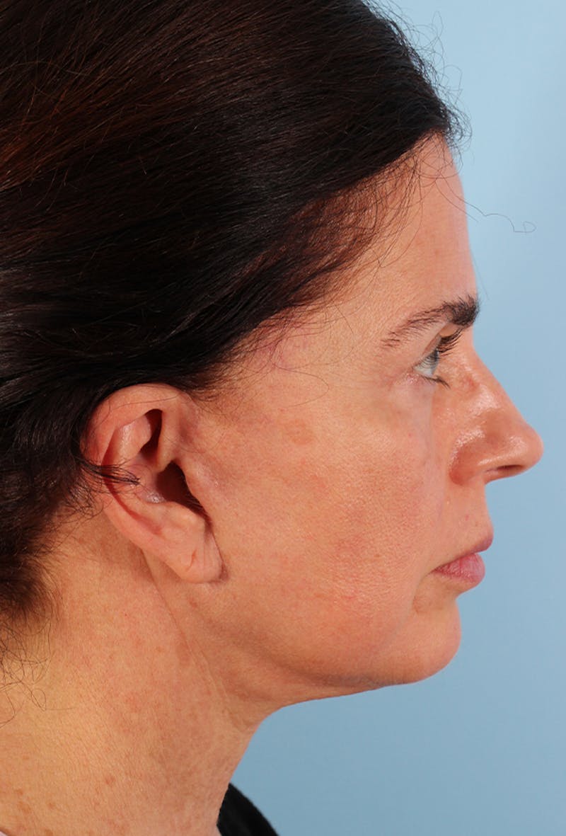 Upper Blepharoplasty Before & After Gallery - Patient 135495 - Image 6