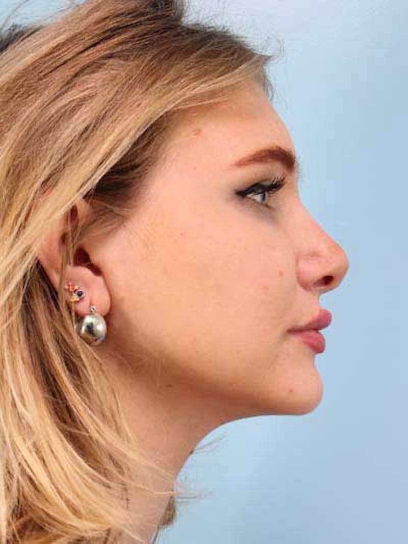 Rhinoplasty Before & After Gallery - Patient 291106 - Image 6