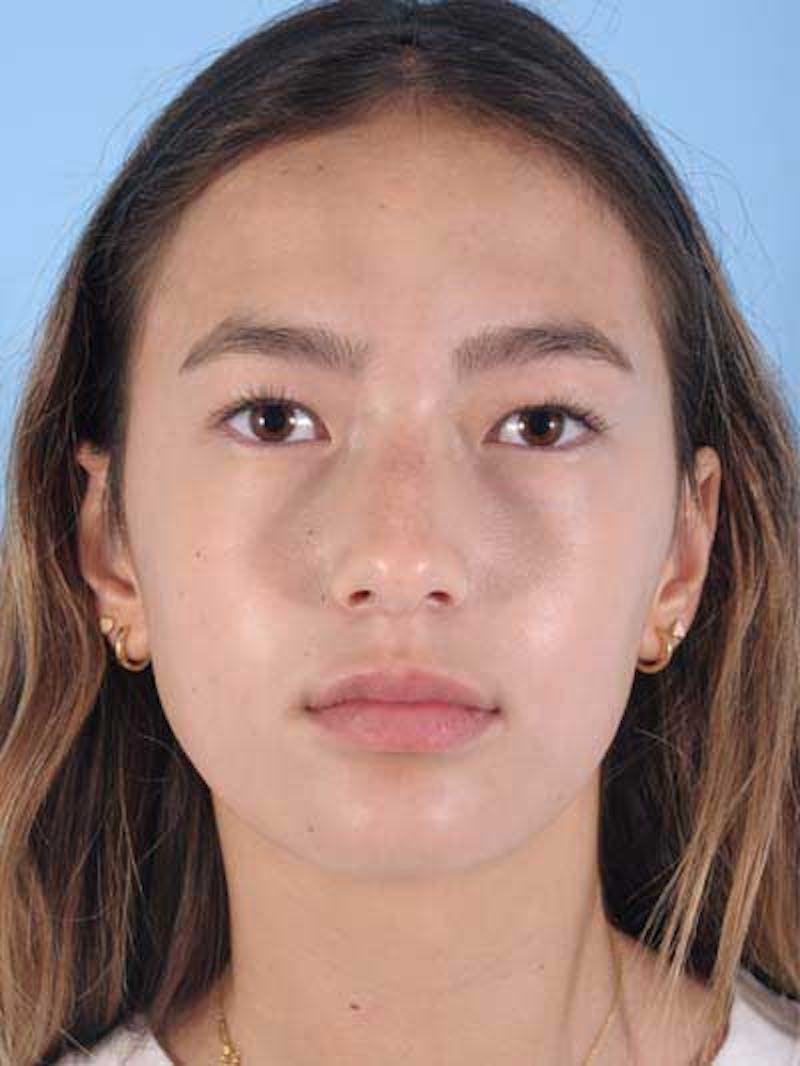 Rhinoplasty Before & After Gallery - Patient 356935 - Image 3