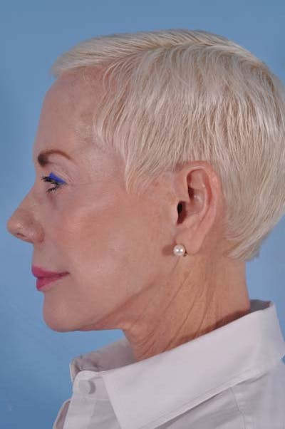 Neck Lift Before & After Gallery - Patient 278174 - Image 1