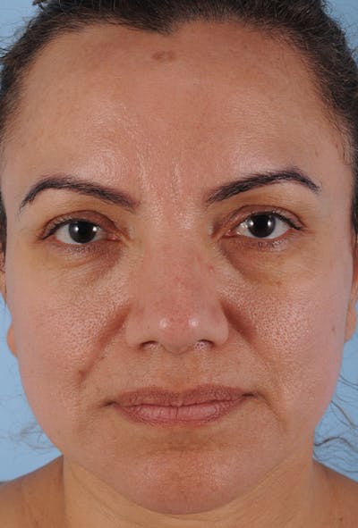 Upper Blepharoplasty Before & After Gallery - Patient 299863 - Image 1