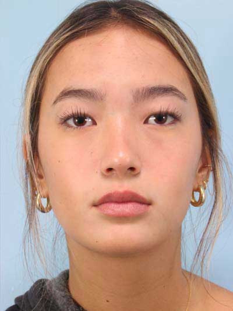 Rhinoplasty Before & After Gallery - Patient 356935 - Image 4