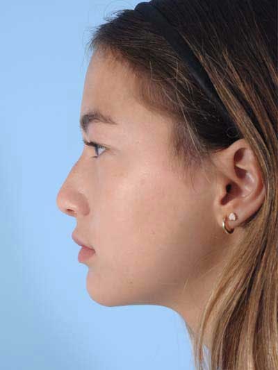 Rhinoplasty Before & After Gallery - Patient 356935 - Image 1
