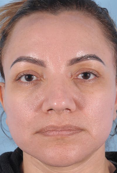 Upper Blepharoplasty Before & After Gallery - Patient 299863 - Image 2