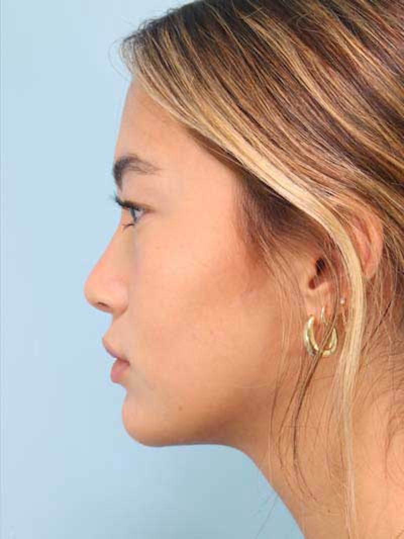 Rhinoplasty Before & After Gallery - Patient 356935 - Image 2