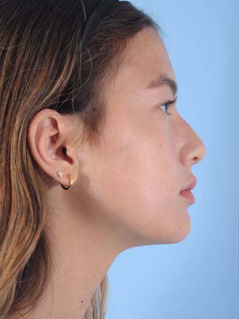 Rhinoplasty Before & After Gallery - Patient 356935 - Image 5