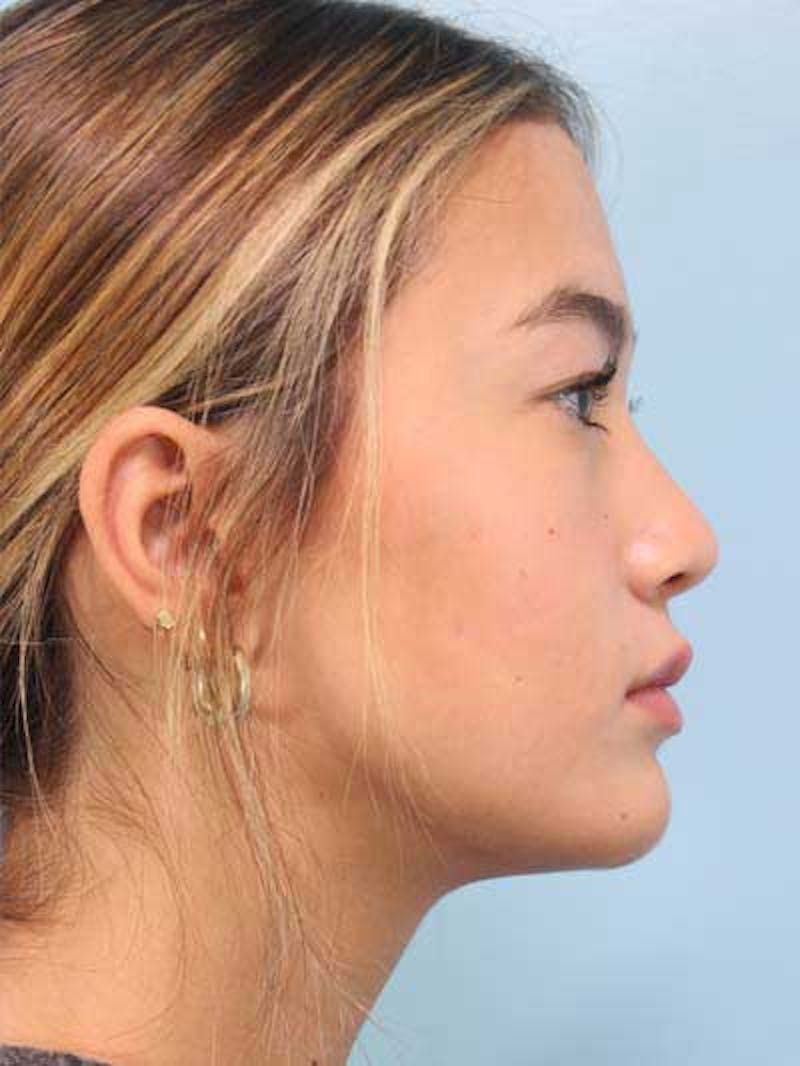 Rhinoplasty Before & After Gallery - Patient 356935 - Image 6