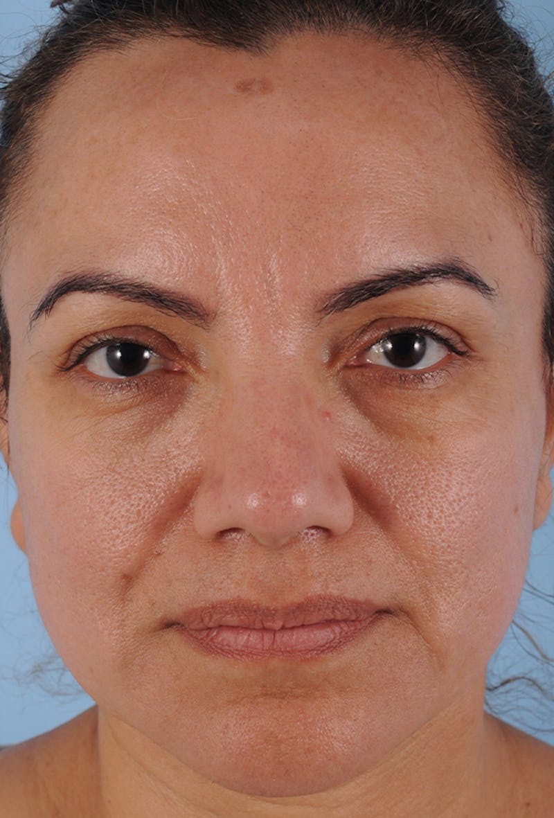 Lower Blepharoplasty Before & After Gallery - Patient 200191 - Image 1