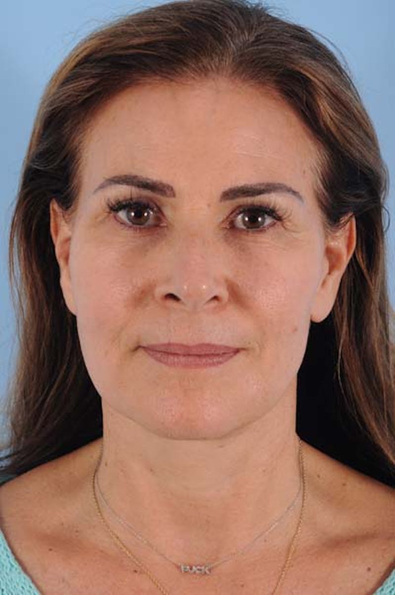 Neck Lift Before & After Gallery - Patient 421465 - Image 4