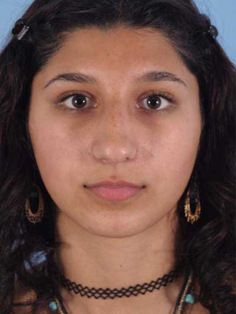 Rhinoplasty Before & After Gallery - Patient 225360 - Image 3