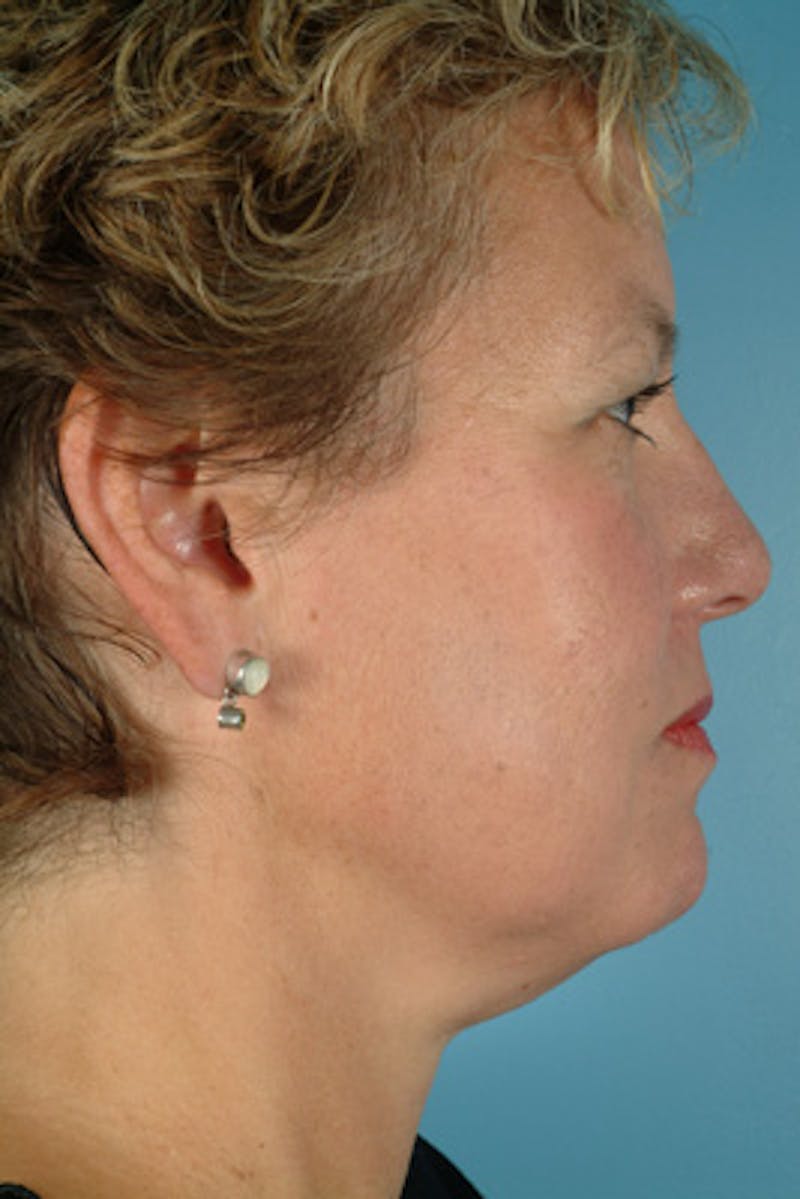 Facelift Before & After Gallery - Patient 189692 - Image 3