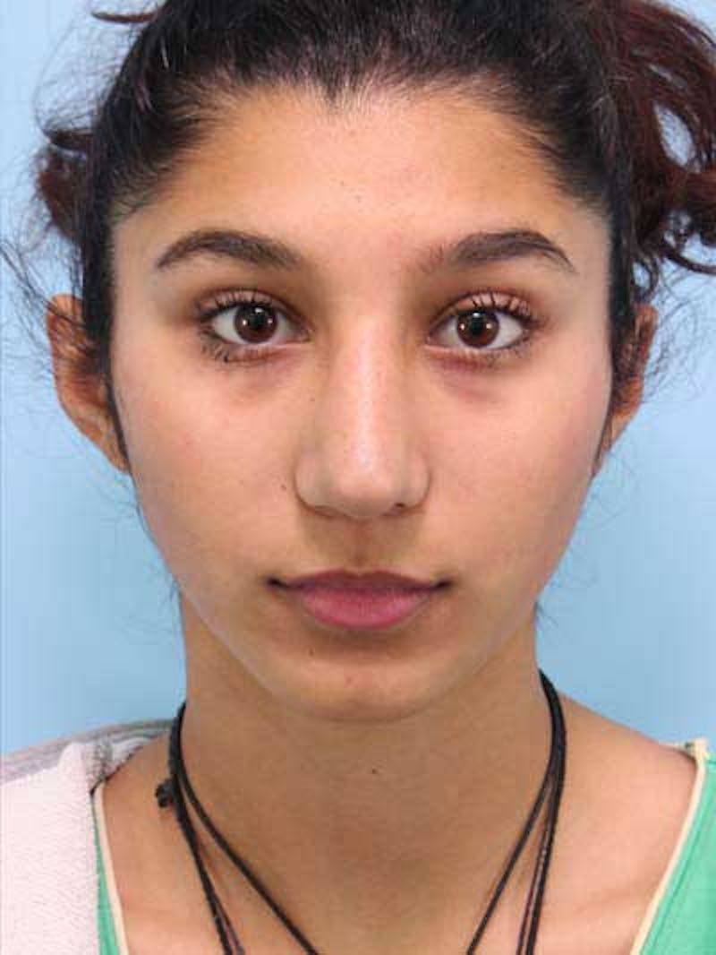 Rhinoplasty Before & After Gallery - Patient 225360 - Image 4
