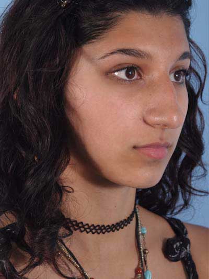 Rhinoplasty Before & After Gallery - Patient 225360 - Image 5