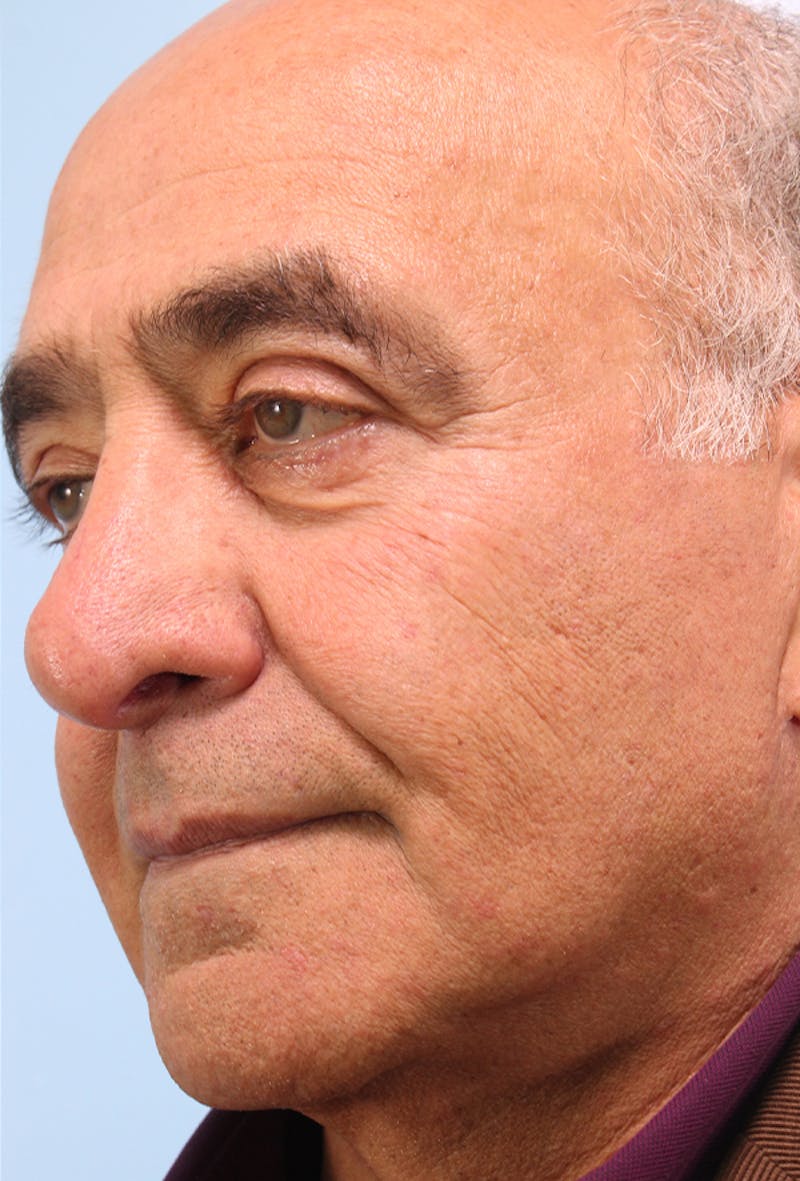 Upper Blepharoplasty Before & After Gallery - Patient 165838 - Image 4