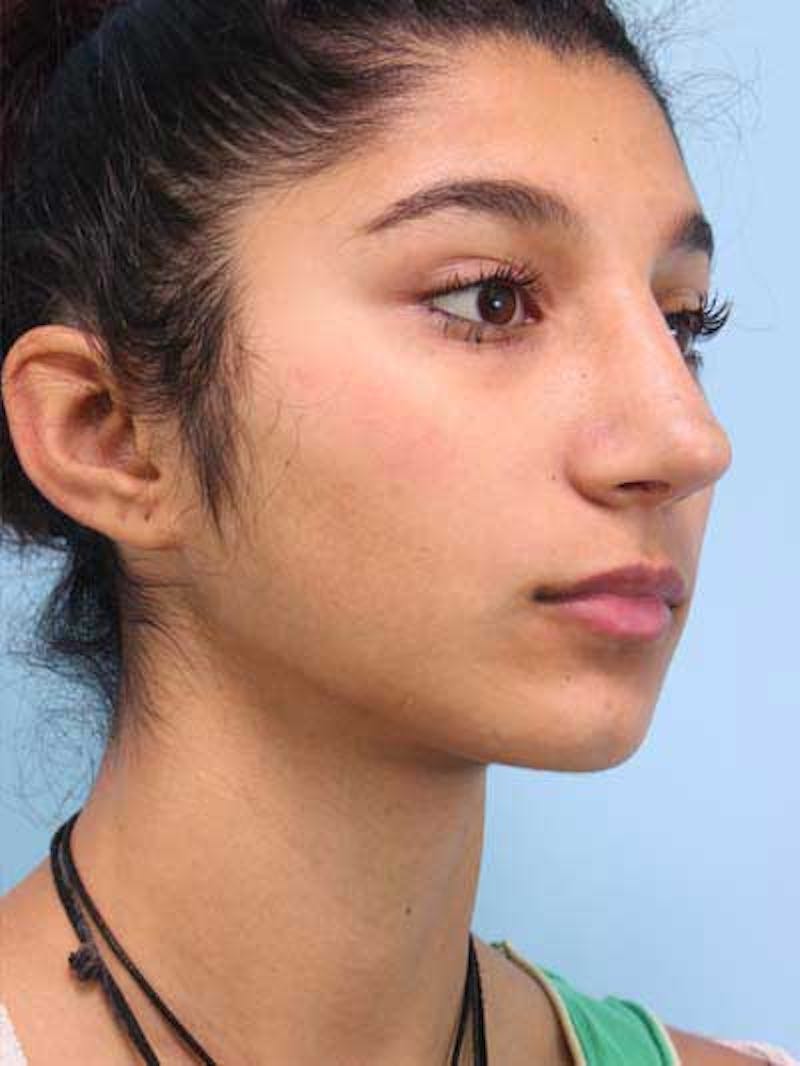 Rhinoplasty Before & After Gallery - Patient 225360 - Image 6